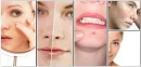 How to Get Rid of Pimples on the Body?