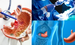 Mide Aldırma İşlemi Kalıcı Bir Çözüm Müdür?