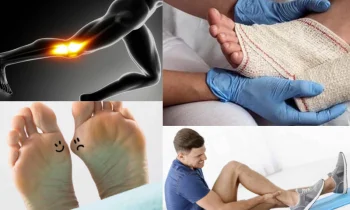 Çekiç Parmak Ameliyatı Sonrası İyileşme Süreci